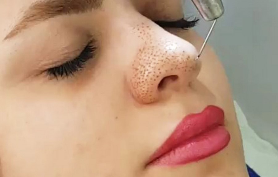 کوچک کردن بینی بدون عمل جراحی کوچک کردن بینی بدون عمل با پلاسماجت